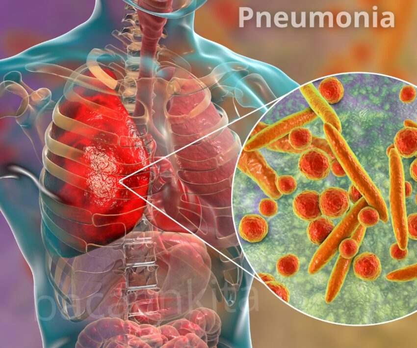 Penyebab Pneumonia yang Wajib Diwaspadai! Ini 5 Faktor Utama yang Bikin Paru-Paru Terancam 1 Pneumonia