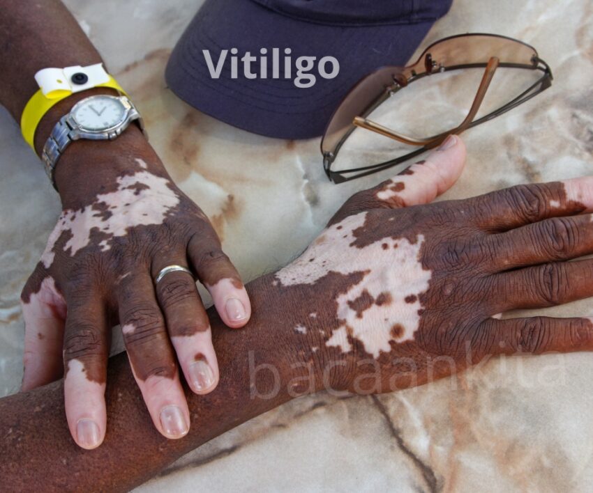 Penyebab Vitiligo: 8 Hidden Triggers yang Harus Lo Waspadai Sebelum Terlambat! 1 vitiligo