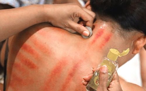 6 cara cepat buat ngilangin masuk angin