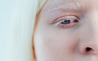 Waardenburg Syndrome 2